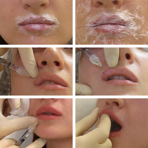 Введение филлеров в губы
