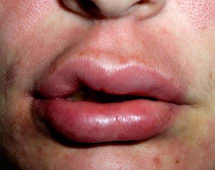 Последствия процедуры коррекции губ филлером