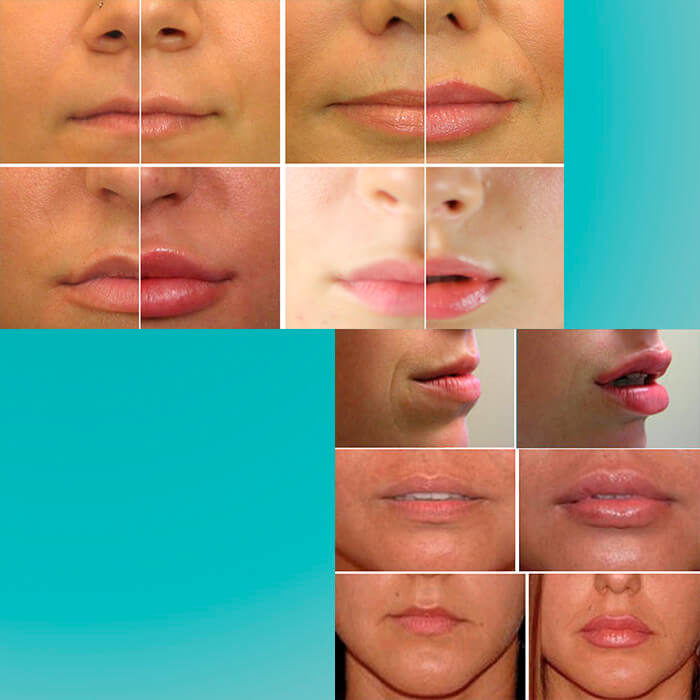 Гиалуроновая кислота в губы до и после