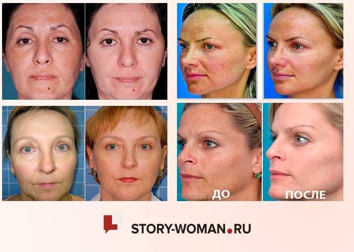 Фото до и после лазерного пилинга кожи лица
