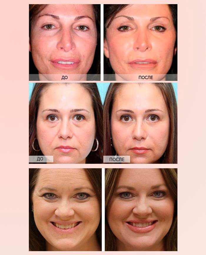 Микротоковая терапия лица: фото до и после