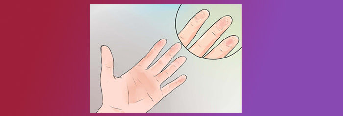 Слезает кожа на пальцах: причины, способы лечения